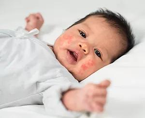 Do Babies Get Acne?