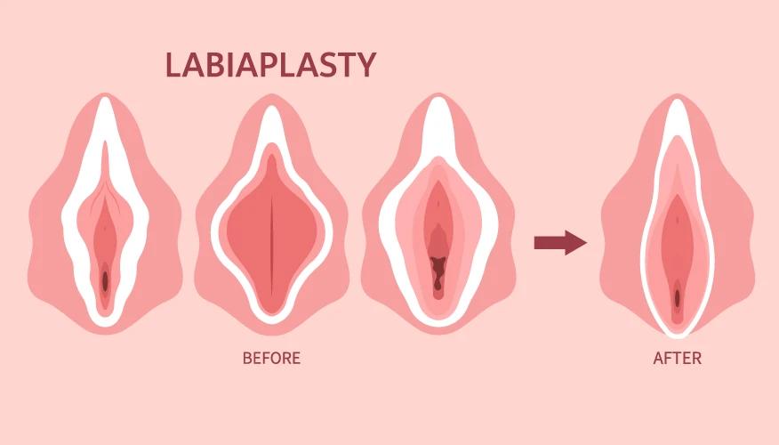 vaginal tightening treatments