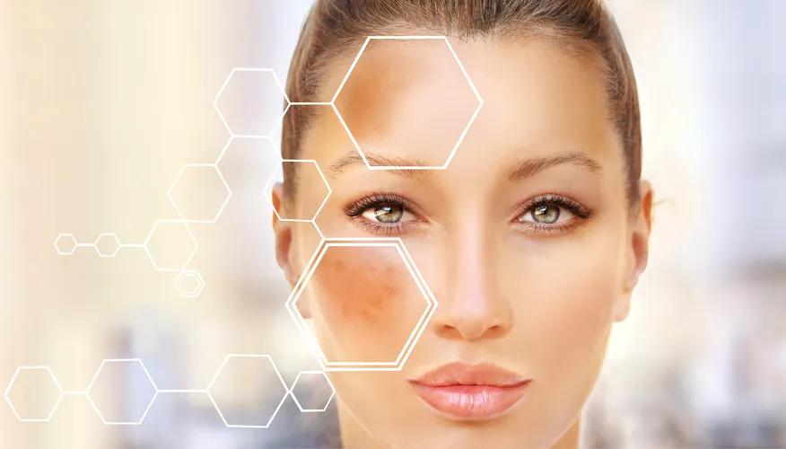  Hyperpigmentation and Dark Spots
