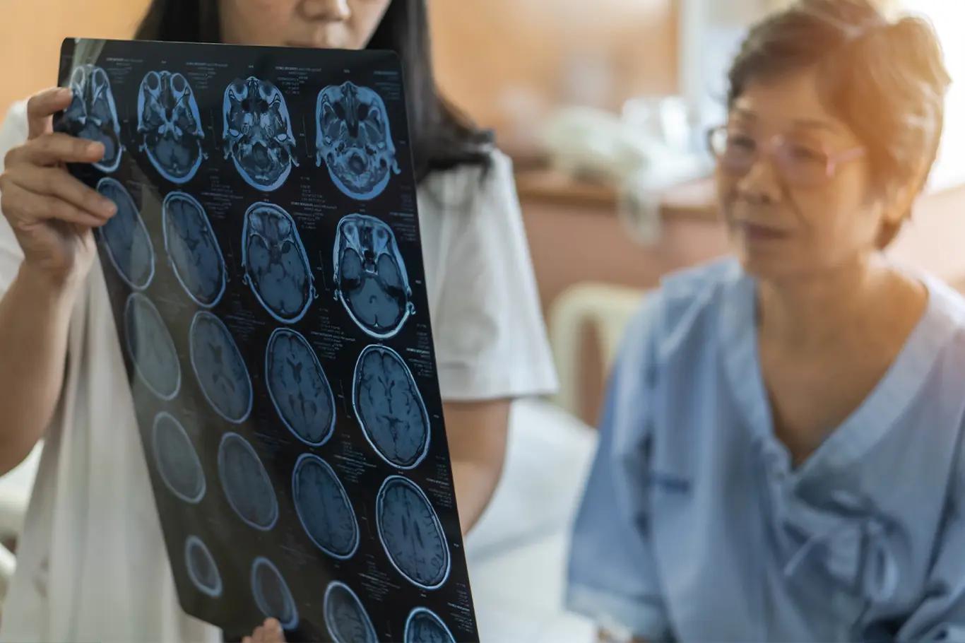 Management of stroke in seniors