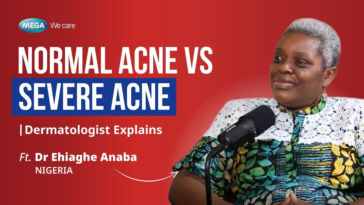 Severe Acne vs Normal Acne: A Dermatologist Explains