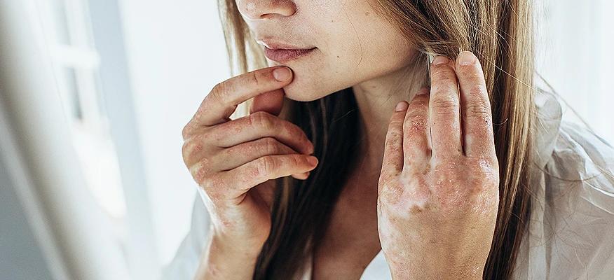 stress related eczema on hands symptoms