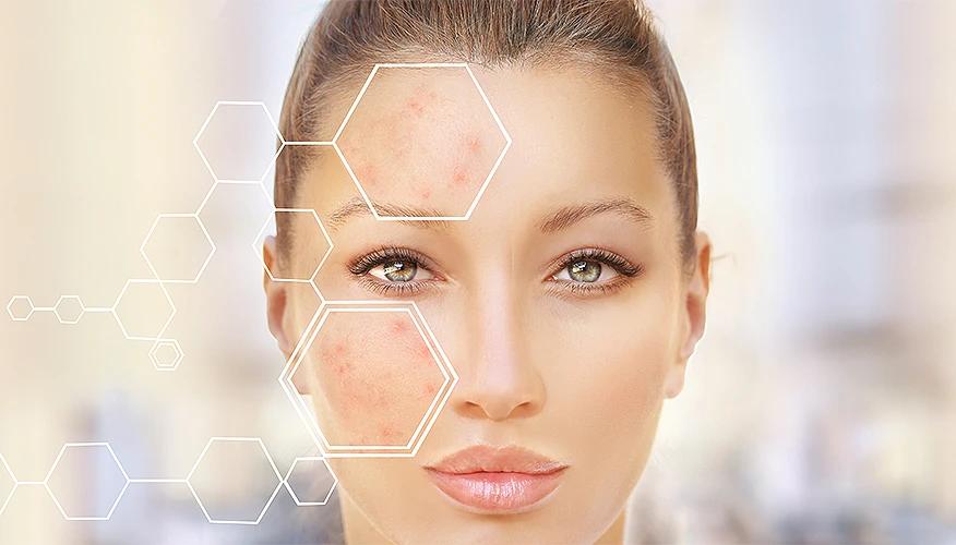 What is acne?