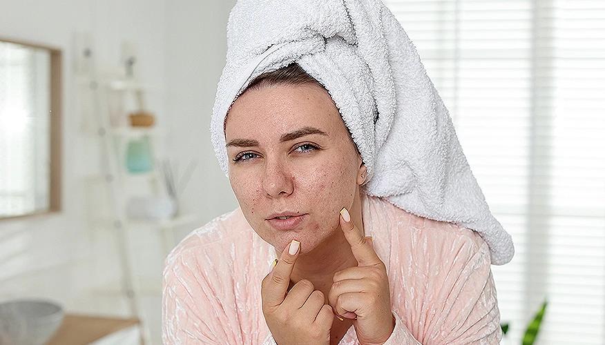 What is hormonal acne