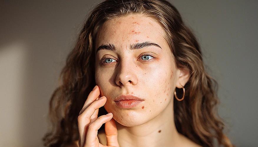 Why do adults get acne