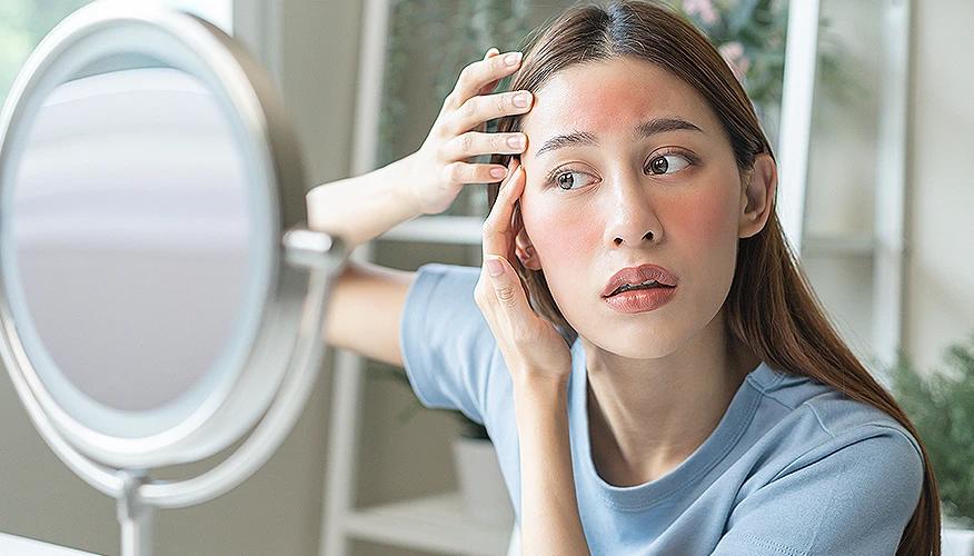 What is steroid acne?