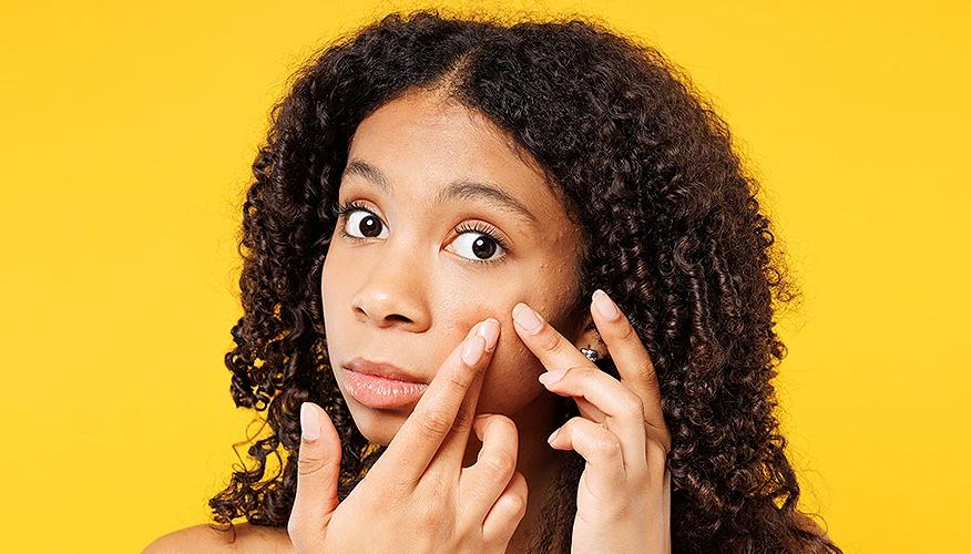 Common types of acne