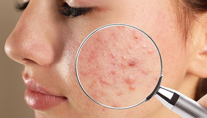 What happens when a pimple forms