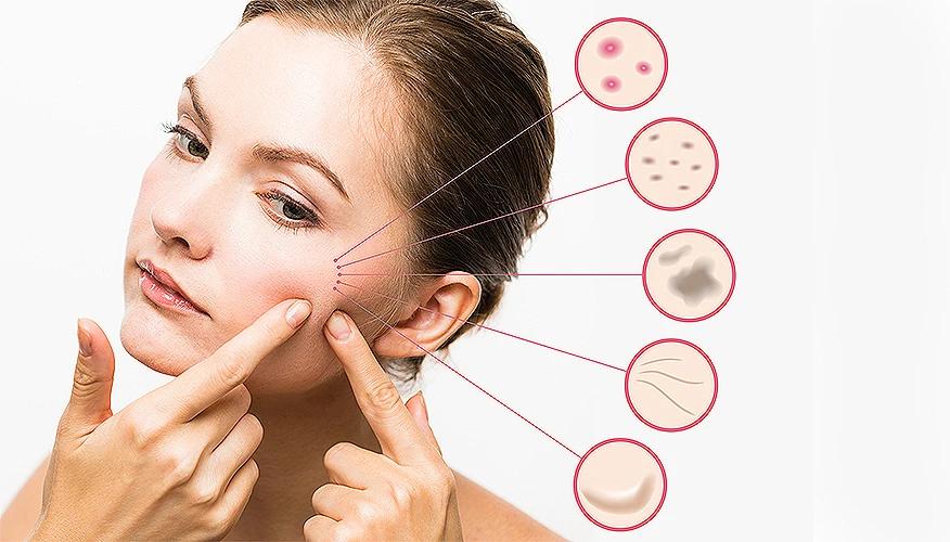 Acne is a medical condition, not just a cosmetic issue
