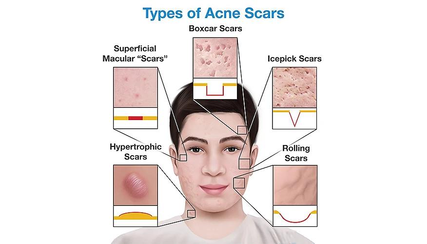 Common types of acne scars