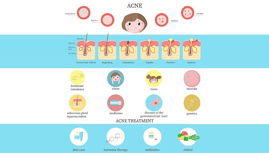 Underlying factors that contribute to acne breakouts