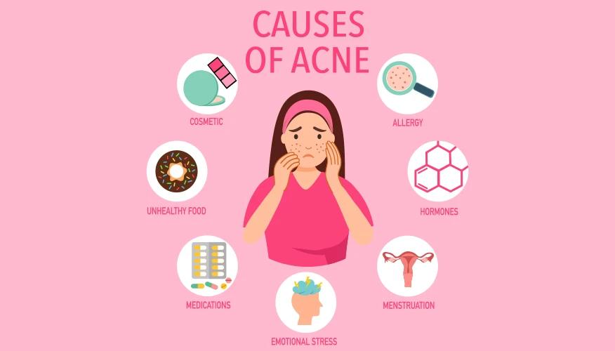 What causes acne on cheeks