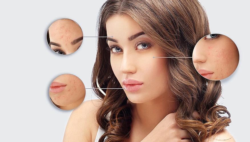 Understanding acne as a medical condition