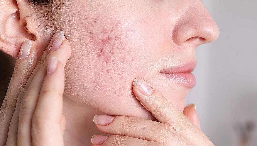 What are acne scars