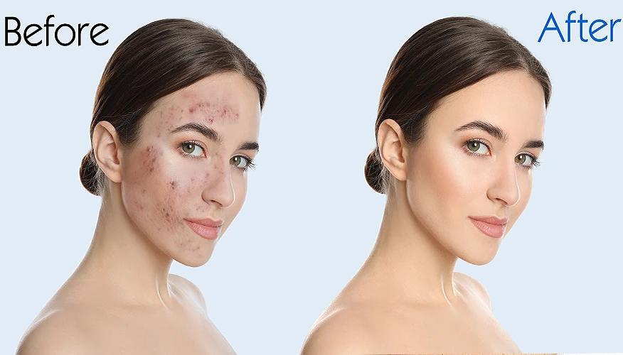 Are skin resurfacing procedures safe