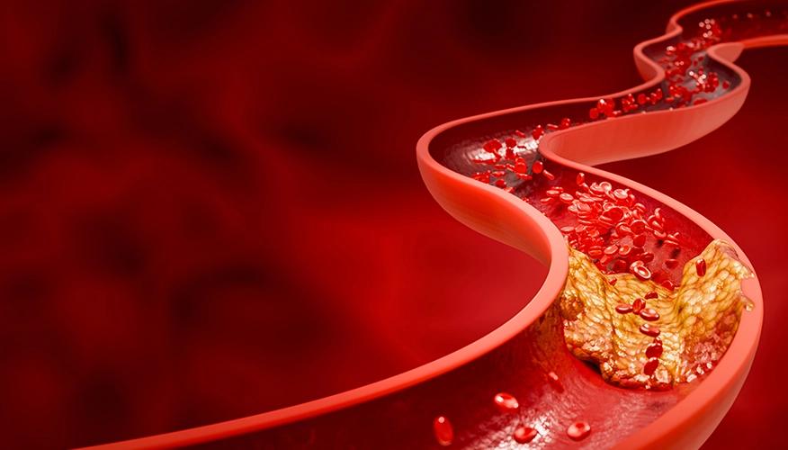 Cardiovascular Disease and the Silent Threat