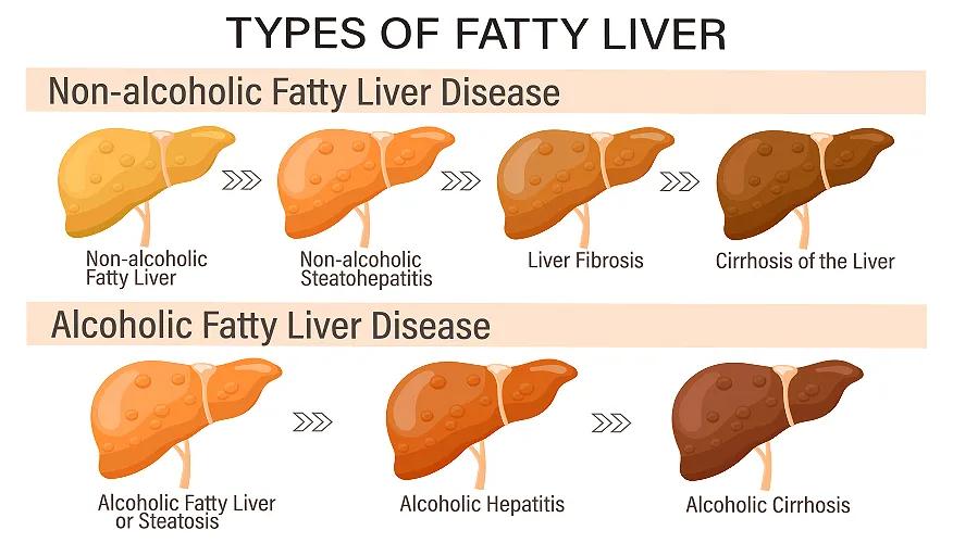 Fatty liver disease types
