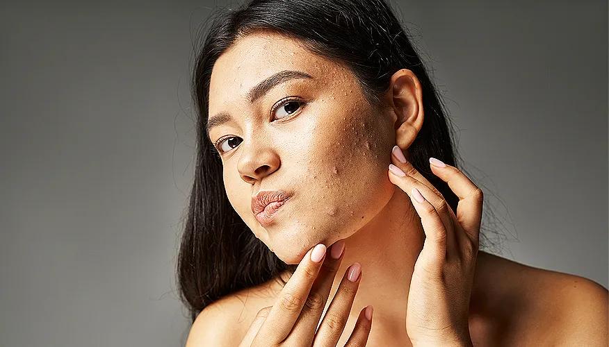 Is there a link between peanut butter and acne?