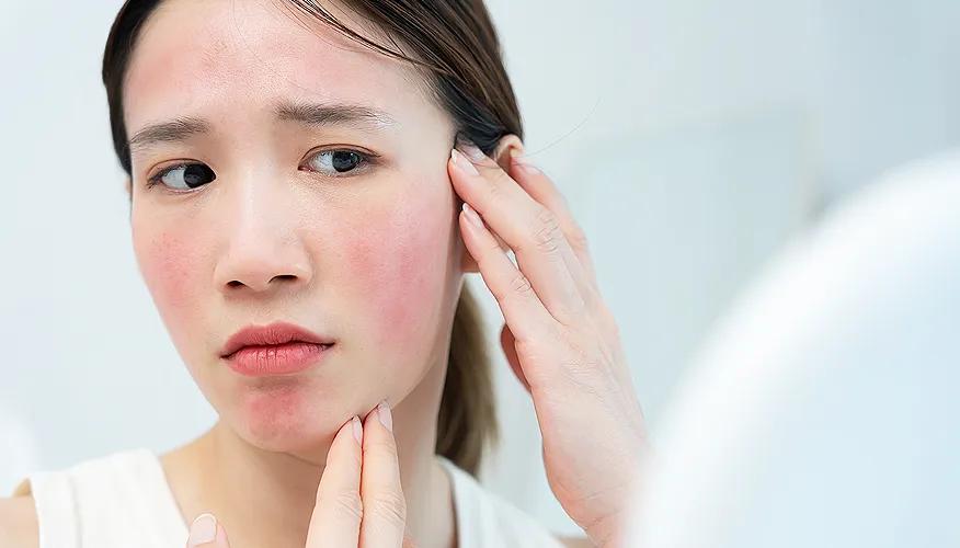 Signs of sensitive skin