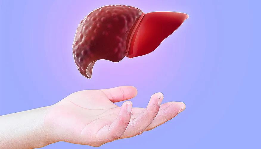 What is cirrhosis of the liver?