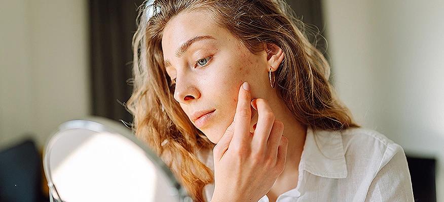 Why You Get Acne On Cheeks And How To Treat It
