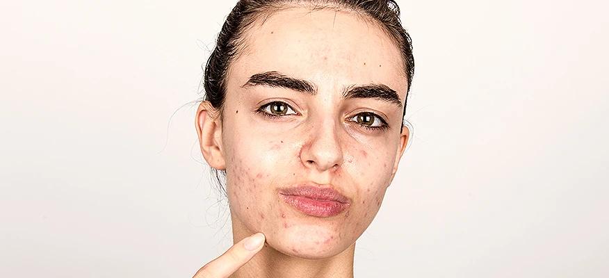 Effective Severe Acne Treatment: Why OTC Isn't Enough