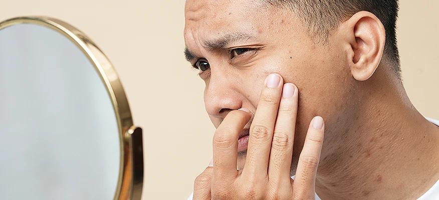 Effective Strategies for Men’s Acne Treatment