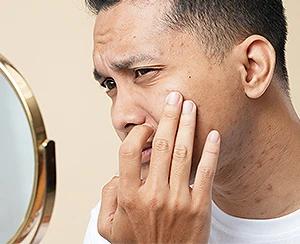 Effective Strategies for Men’s Acne Treatment