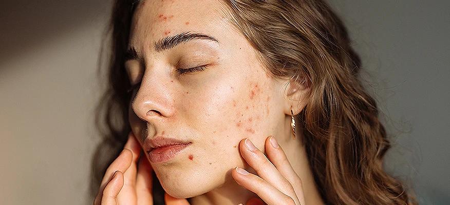 Understanding Acne: Causes, Treatments, Prevention