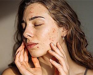Understanding Acne: Causes, Treatments, Prevention