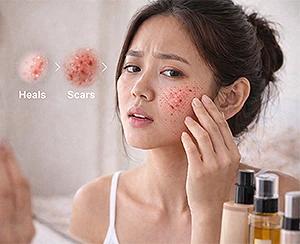 Understanding Acne Scars: Causes and Prevention Tips