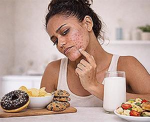Top 10 Foods That Trigger Acne: A Guide for Clear Skin