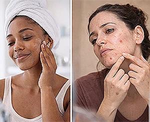 Self-Care vs Dermatologist: Finding the Best Acne Solution