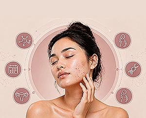 Understanding Hormonal Acne: Causes, Symptoms, and Treatments