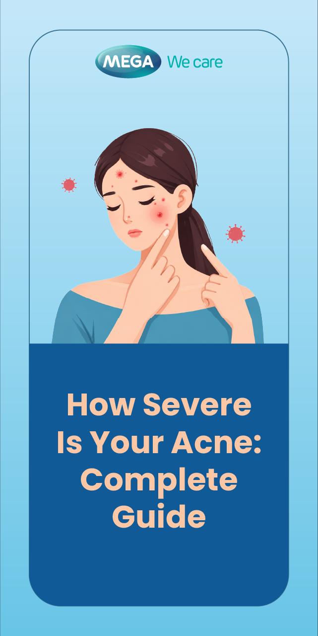 How Severe is Your Acne