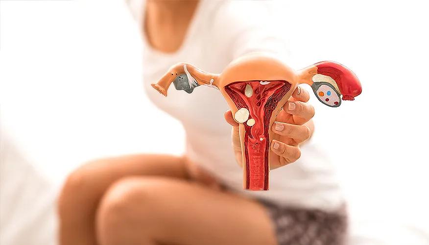 Understanding endometriosis